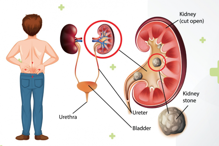 Mengenal Kode ICD 10 Pada Penyakit Batu Ginjal atau Nefrolitiasis, Berikut Gejala yang Menyertai!