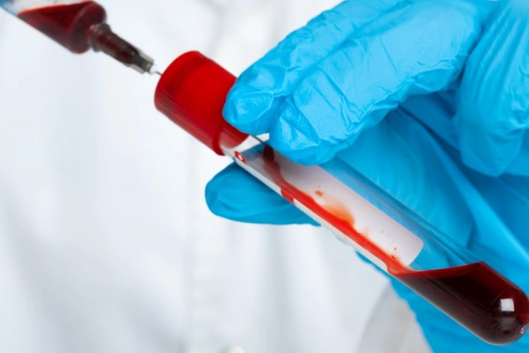 Cara Cek Darah HB di Puskesmas Pakai BPJS, Sangat Disarankan Guna Memantau Kondisi Kesehatan 