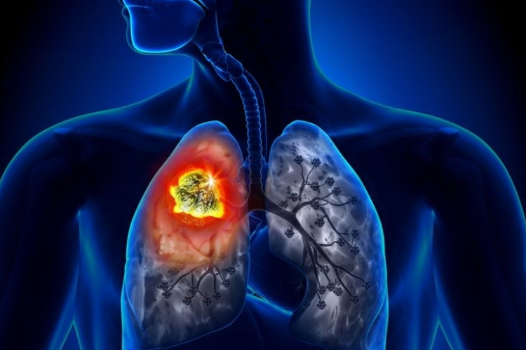 Kode ICD 10 Pada Penyakit TBC (Tuberkulosis Paru) Terlengkap, Beserta Penyebab Umumnya!