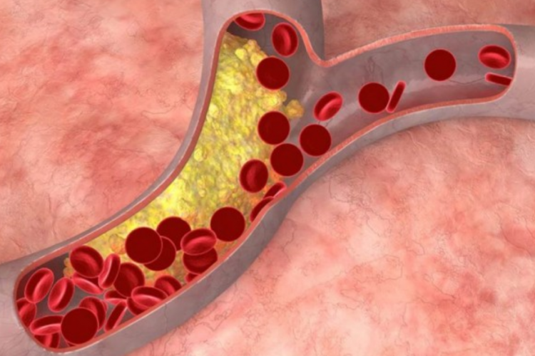 Waspada! Gejala Penyakit Kolesterol Tinggi, Beserta Bahayanya yang Bisa Menyerang Segala Usia