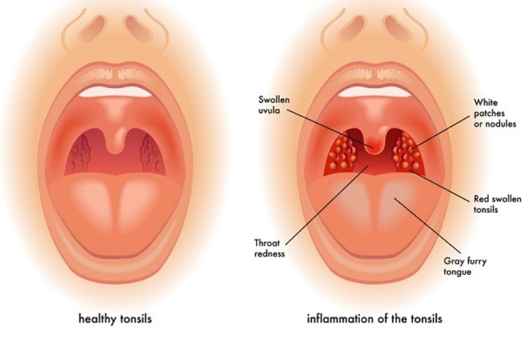 Penyebab Tonsilofaringitis Atau Sakit Tenggorokan Lengkap Dengan Cara Mengatasinya 