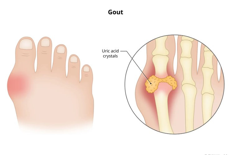 Daftar Kode ICD 10 Gout Arthritis, Benjolan di Kaki yang Kerap Disepelekan, Bisa Bahaya! 