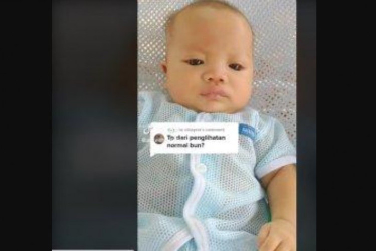 Bayi Bermata Unik di Malaysia Viral Disebut Mirip Alien, Begini Penyebab Kondisi Mata Tersebut