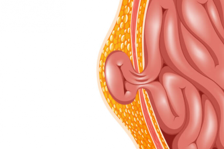 Penyakit Hernia Inguinalis: Deteksi Dini, Penyebab, Gejala dan Cara Pengobatan