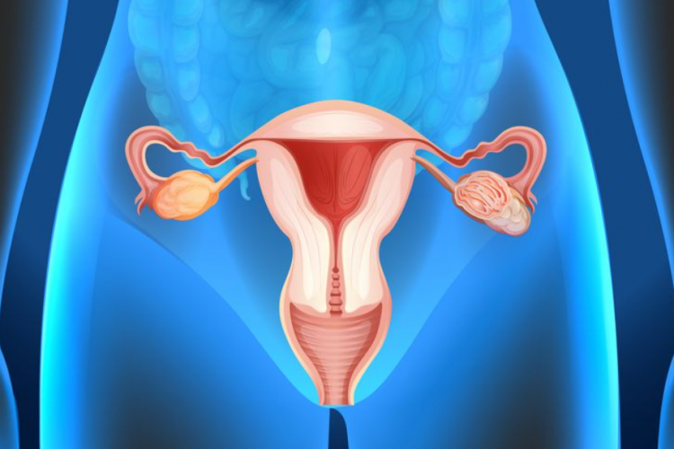 Kode ICD 10 Pada Penyakit Kista Ovarium, Serta Mengenal Beberapa Jenis yang Sering Menyerang!