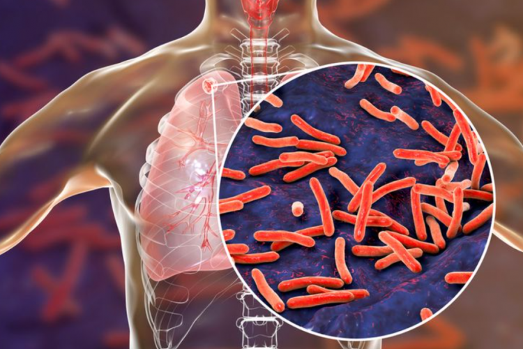 Gejala Umum Penyakit TBC (Tuberkulosis Paru): Penyebab dan Cara Pengobatan