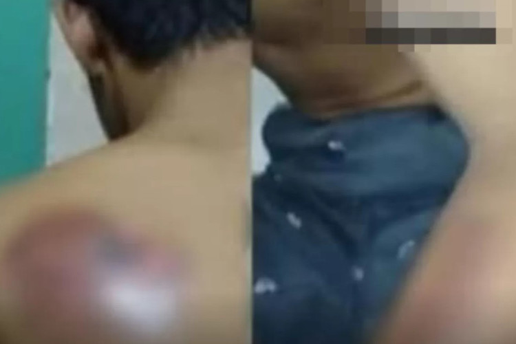 Miris! Santri Difabel Ponpes Gresik Dianiaya Senior, Punggung Disetrika Hingga Alami Luka Bakar Parah