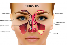 Obat Herbal Sinusitis Ampuh dan Bisa Meringankan, Konsumsi Rutin Supaya Hasil Maksimal!