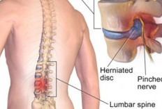 ICD 10 HNP Adalah? Pengertian serta Peran dalam Mendiagnosa