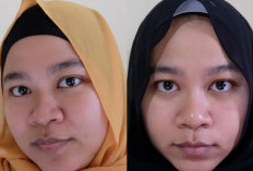 Harga Suntik Botox di Erha Terbaru Tahun 2023, Harga Mulai 100 Ribuan Langsung Cantik Seketika!