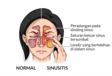 Penyakit Sinusitis: Penyebab, Gejala dan Cara Mengobatinya yang Ampuh!