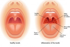 Penyebab Tonsilofaringitis Atau Sakit Tenggorokan Lengkap Dengan Cara Mengatasinya 