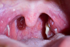 Kode BPJS Tonsilofaringitis Atau Penyakit Tenggorokan Yang Wajib Kamu Tahu 