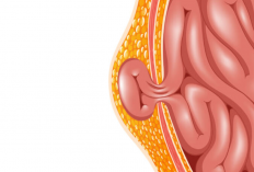 Penyakit Hernia Inguinalis: Deteksi Dini, Penyebab, Gejala dan Cara Pengobatan