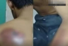 Miris! Santri Difabel Ponpes Gresik Dianiaya Senior, Punggung Disetrika Hingga Alami Luka Bakar Parah