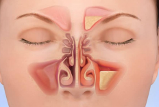 Cara Mengatasi Sinusitis Mudah Cukup Dilakukan di Rumah, Dijamin Akan Mereda!